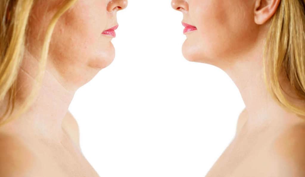 Double Chin treatment Ayr before and after results