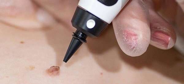 After Skin Tag Removal Ayr