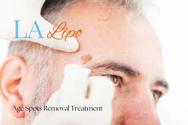 What Are the Most Effective Treatments for Age Spots Ayr?