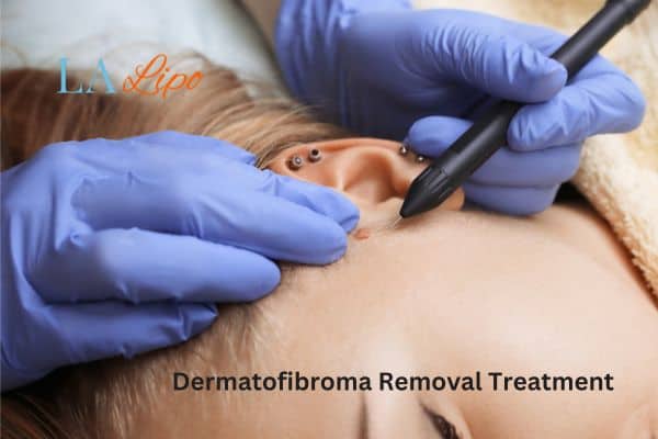 Dermatofibroma Removal Treatment Ayr
