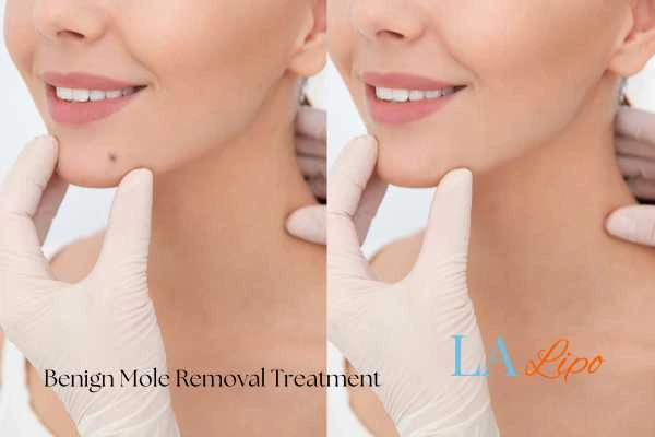 woman's before and after mole removal Ayr results