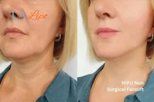 hi-fu for wrinkles Ayr before and after results