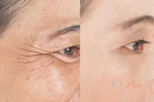 Before and after results of woman - HI-fu wrinkles reduction treatment Ayr