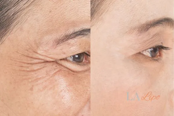 Before and after results of woman - HI-fu wrinkles reduction treatment Ayr