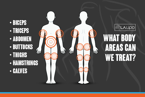 Graphic to show areas you can have LA-EMS Body Sculpting Ayr treatment.