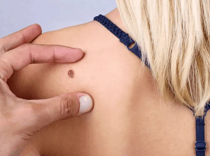 woman having mole removal Ayr consultation before treatment.