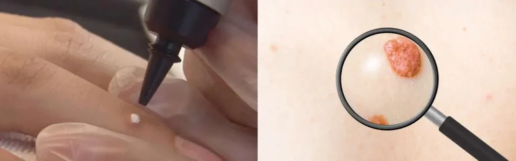 Cryopen for mole removal Ayr - speak to our team today!
