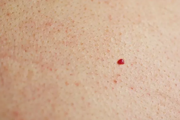 close up of a cherry angioma Ayr