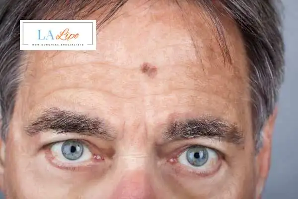 Solar Lentigo Removal Ayr image of man with mark on his forehead