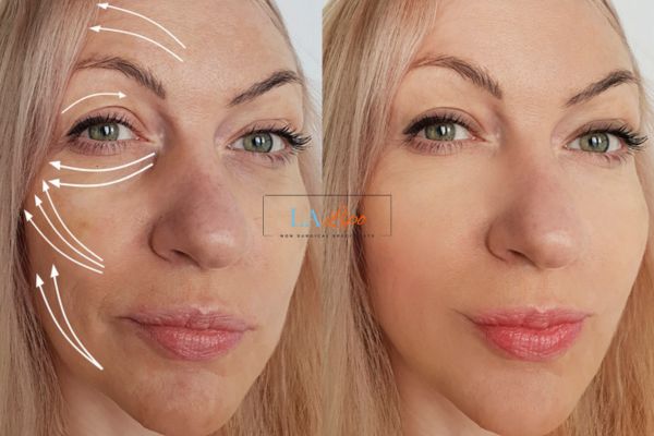 Morpheus 8 results Ayr face lift.