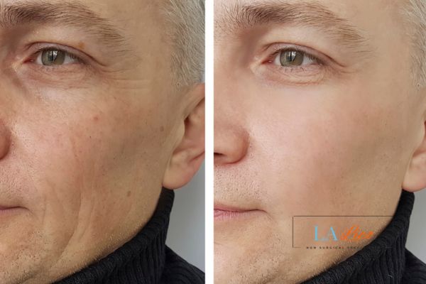 See the amazing results of Morpheus8 Treatment Ayr!