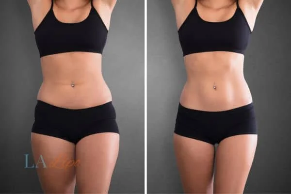 before and after results of non-surgical treatment to help a woman's body image and mental health Ayr