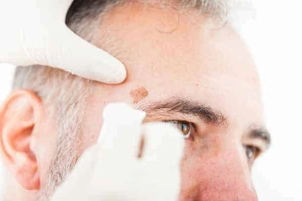 Age spots and elderly people Ayr what is the link?