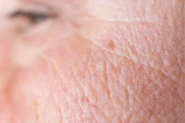 close up picture of a woman's face showing an age spot Ayr