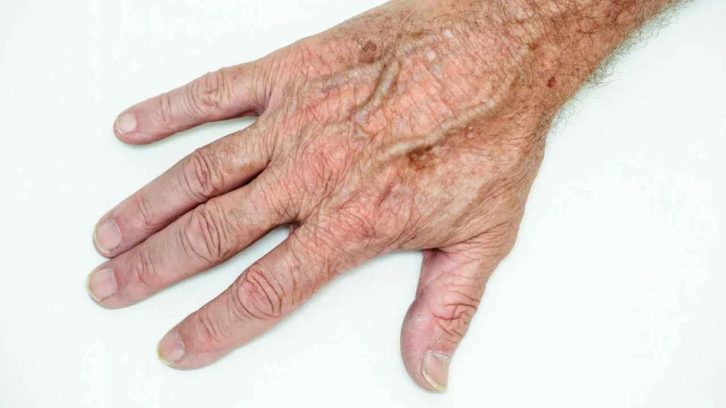 Male hand showing age spot Ayr